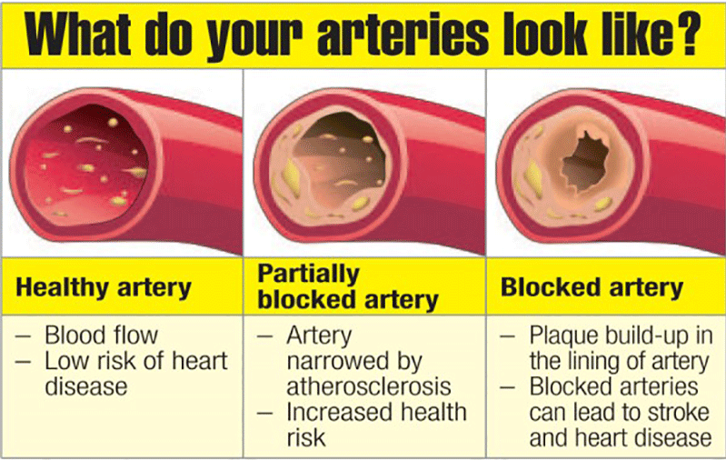 How To Reverse Plaque Buildup In Arteries